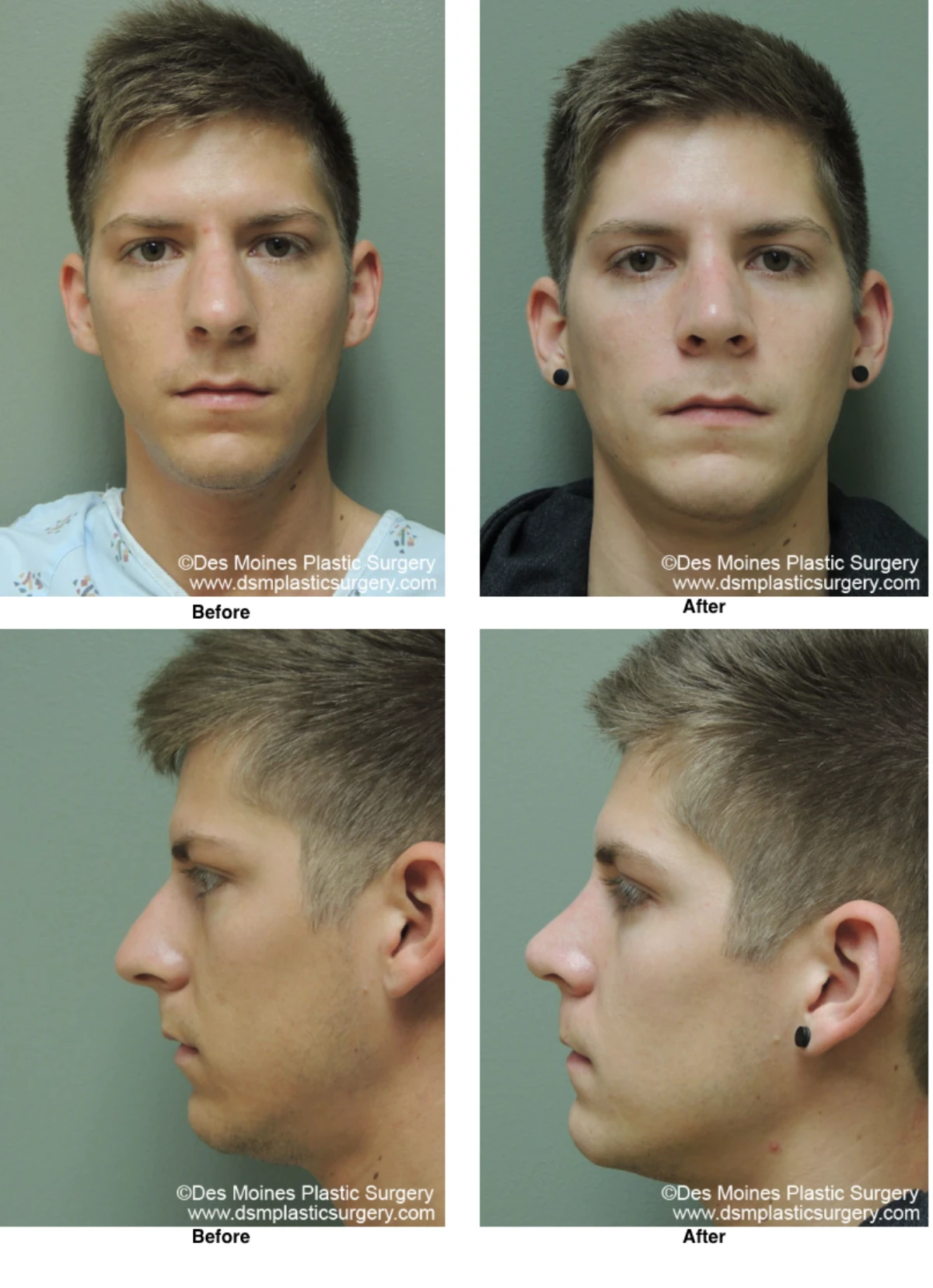 Rhinoplasty Before and After Performed by Dr David Robbins