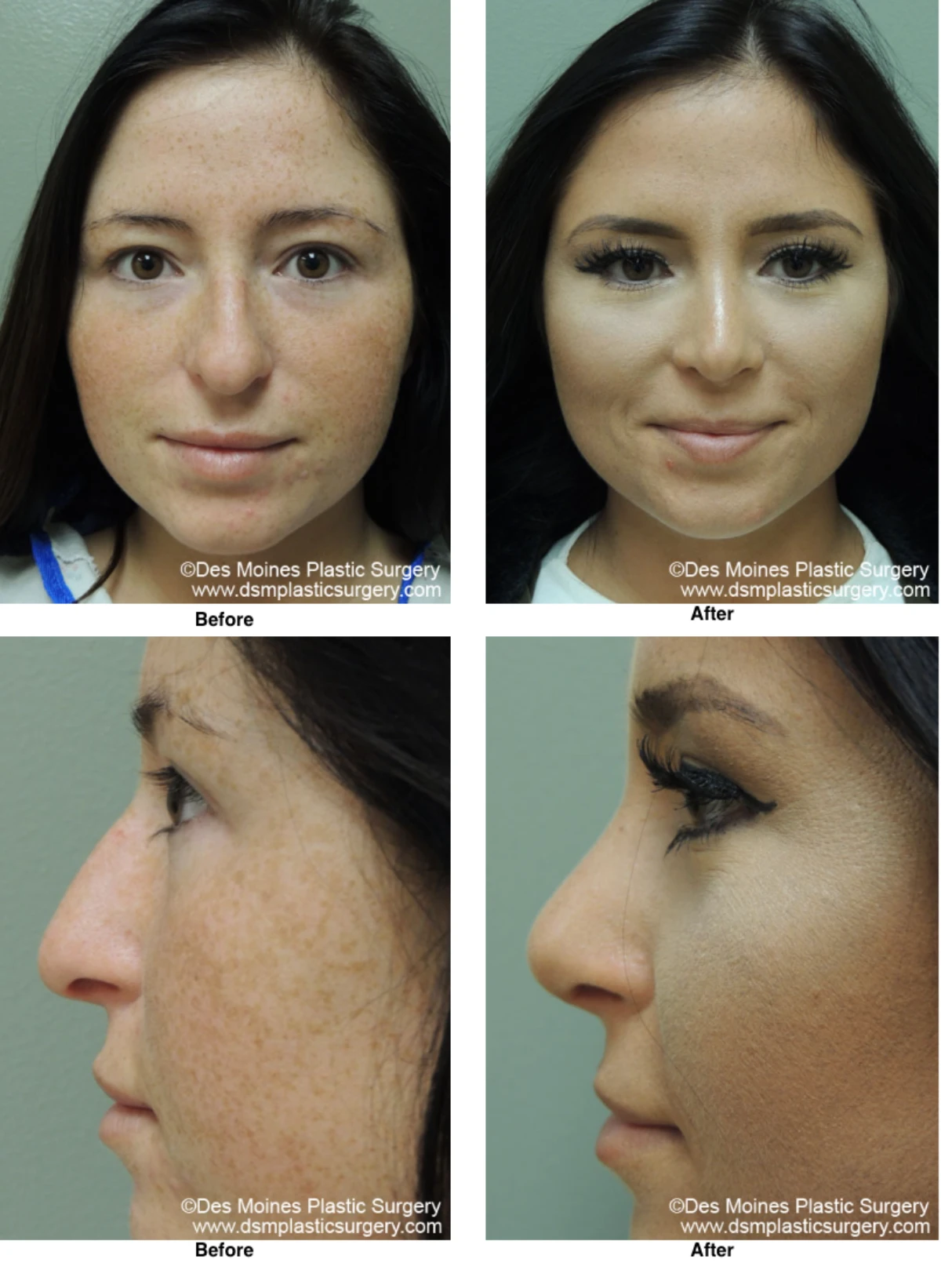 Rhinoplasty Before and After Performed by Dr David Robbins