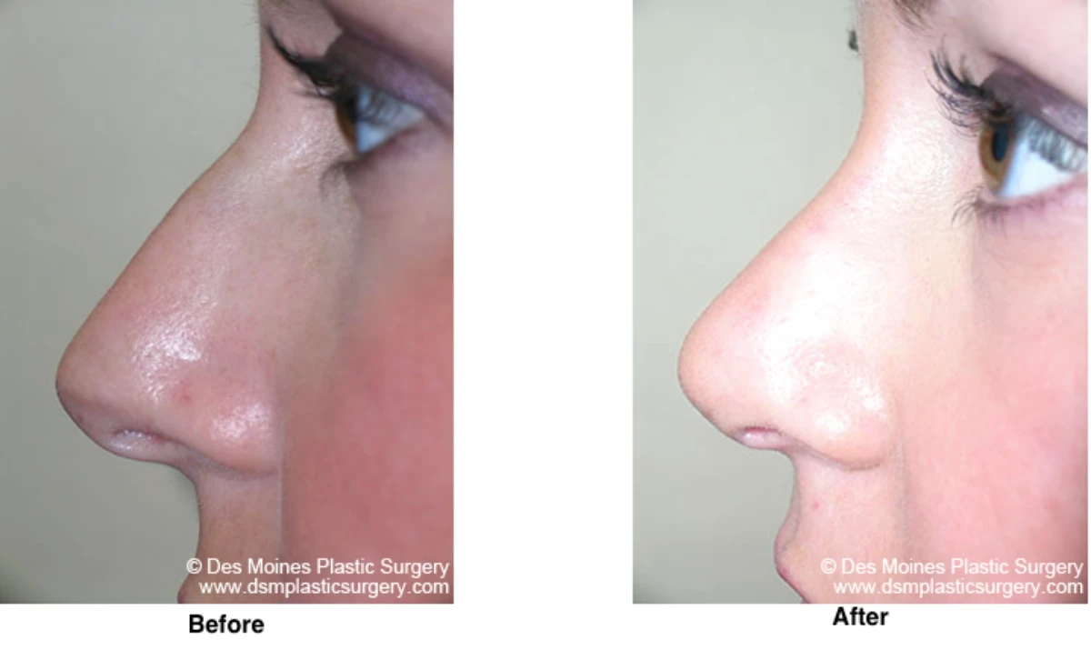 Rhinoplasty Before and After Performed by Dr David Robbins