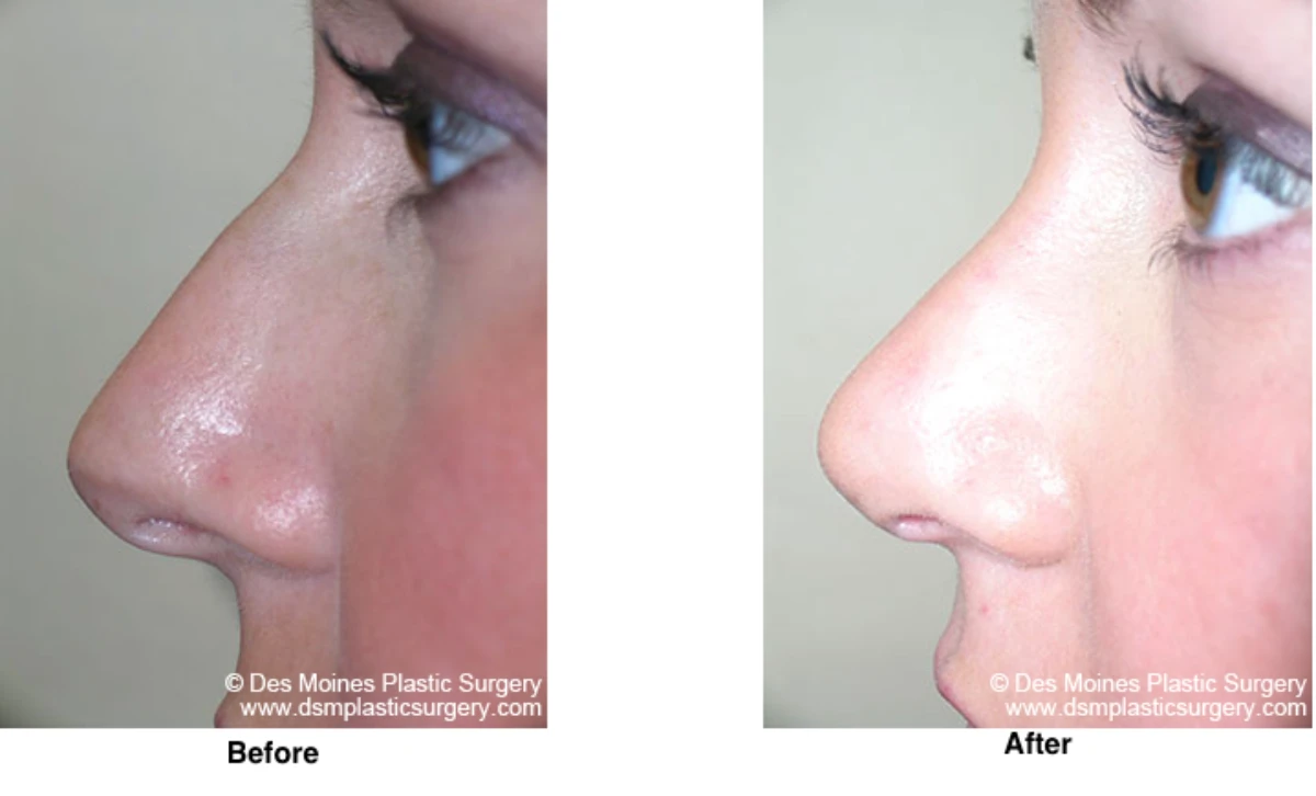 Rhinoplasty Before And After Performed By Dr David Robbins