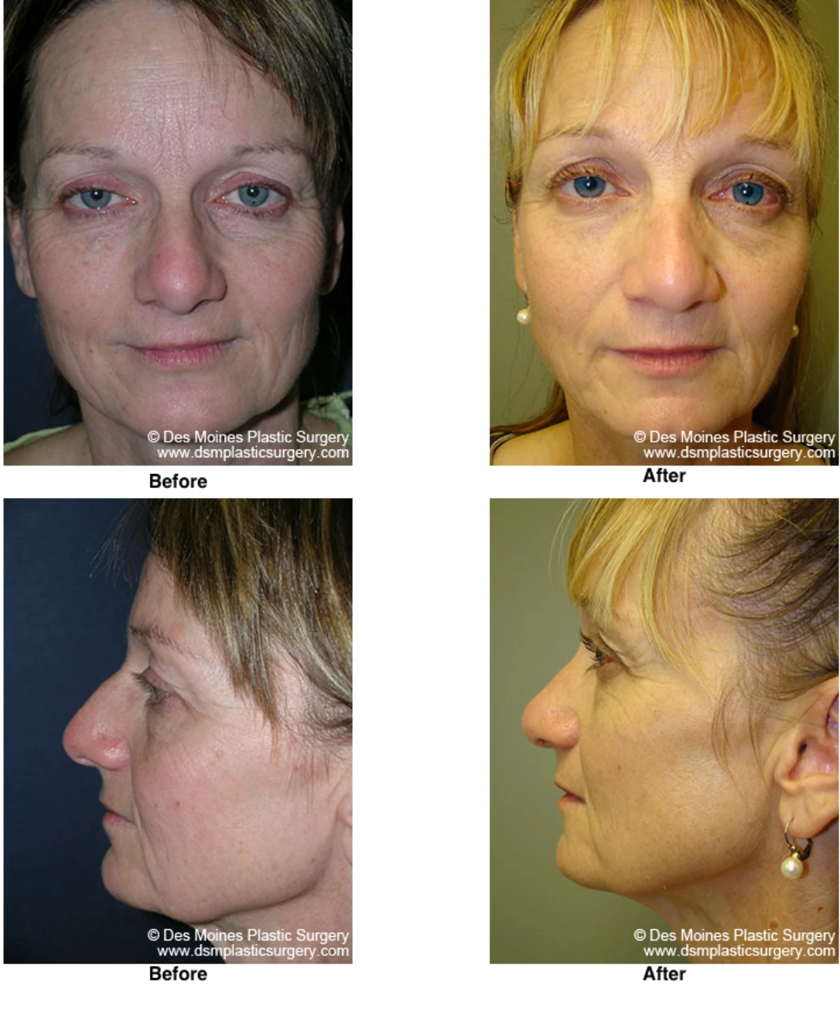 Rhinoplasty Before and After Performed by Dr David Robbins