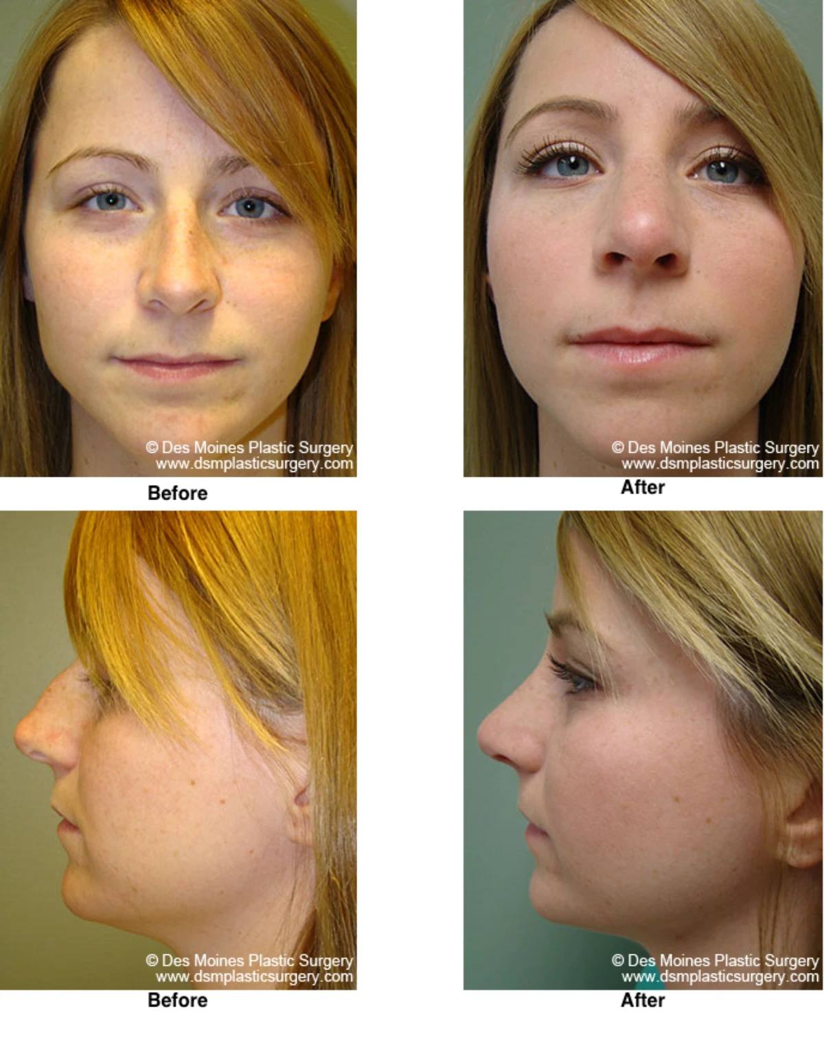 Rhinoplasty Before and After Performed by Dr David Robbins