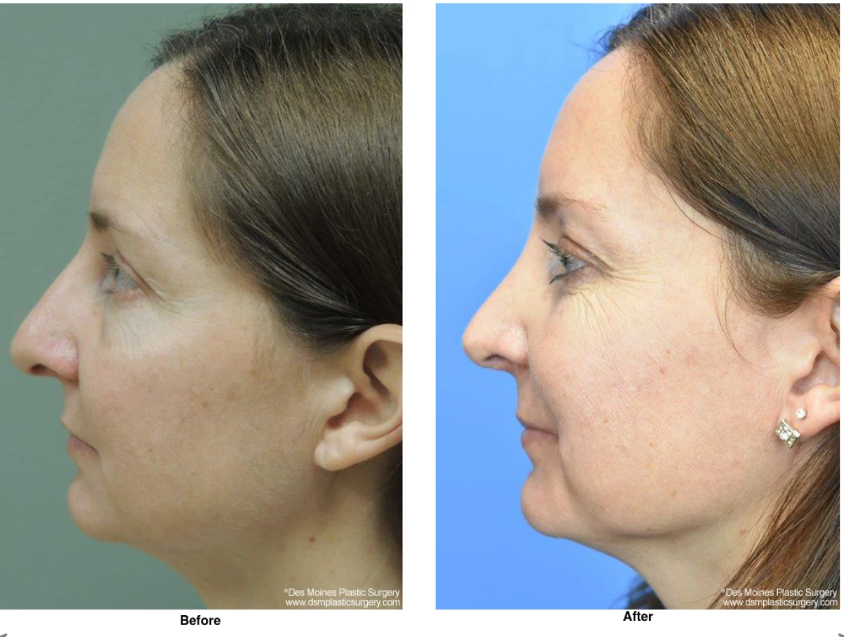 Rhinoplasty Before and After Performed by Dr David Robbins