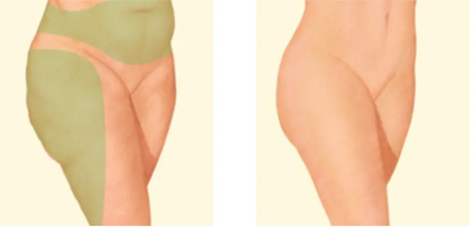 Thighs and Lower Stomach Liposuction Before and After Illustration
