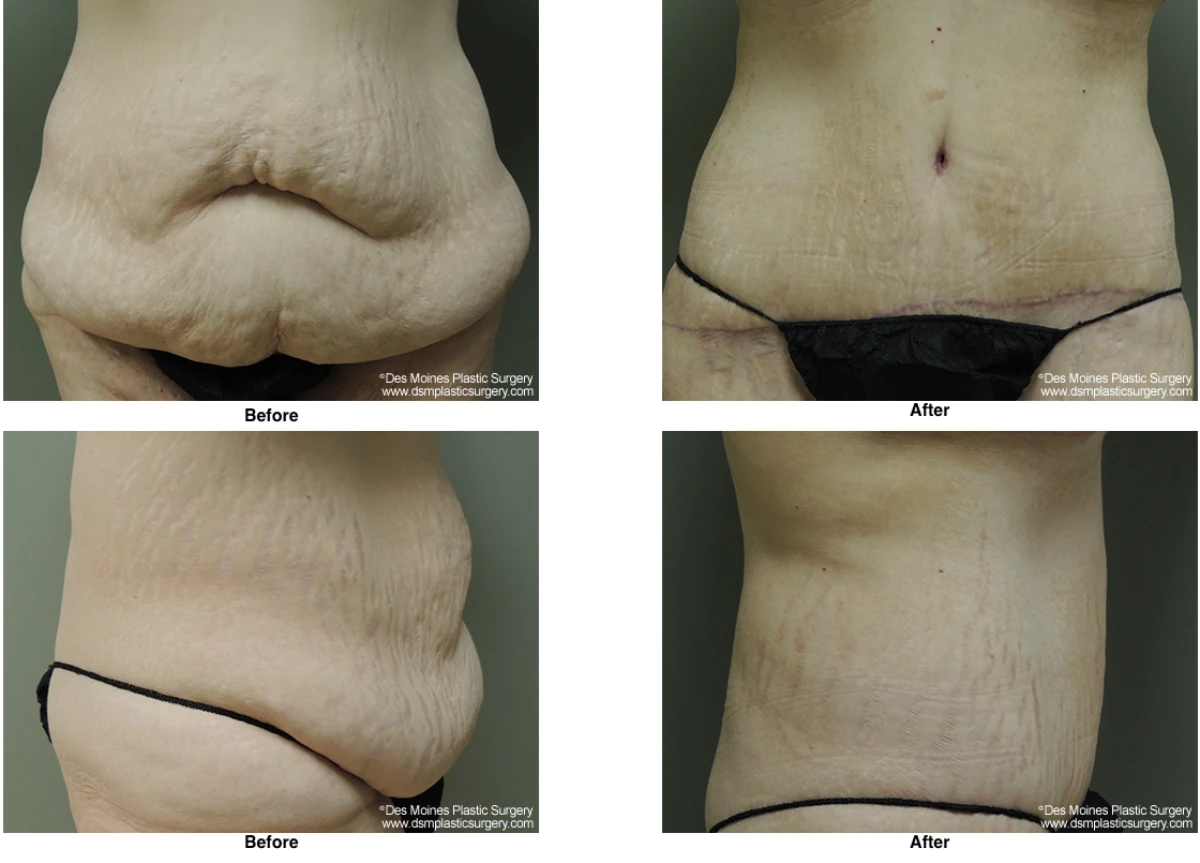 Tummy Tuck Before And After Performed By Dr David Robbins