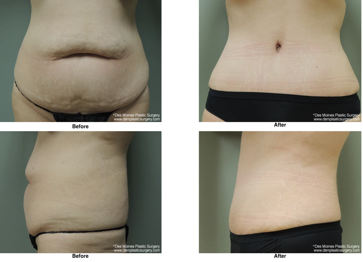 Tummy Tuck Before And After Performed By Dr David Robbins