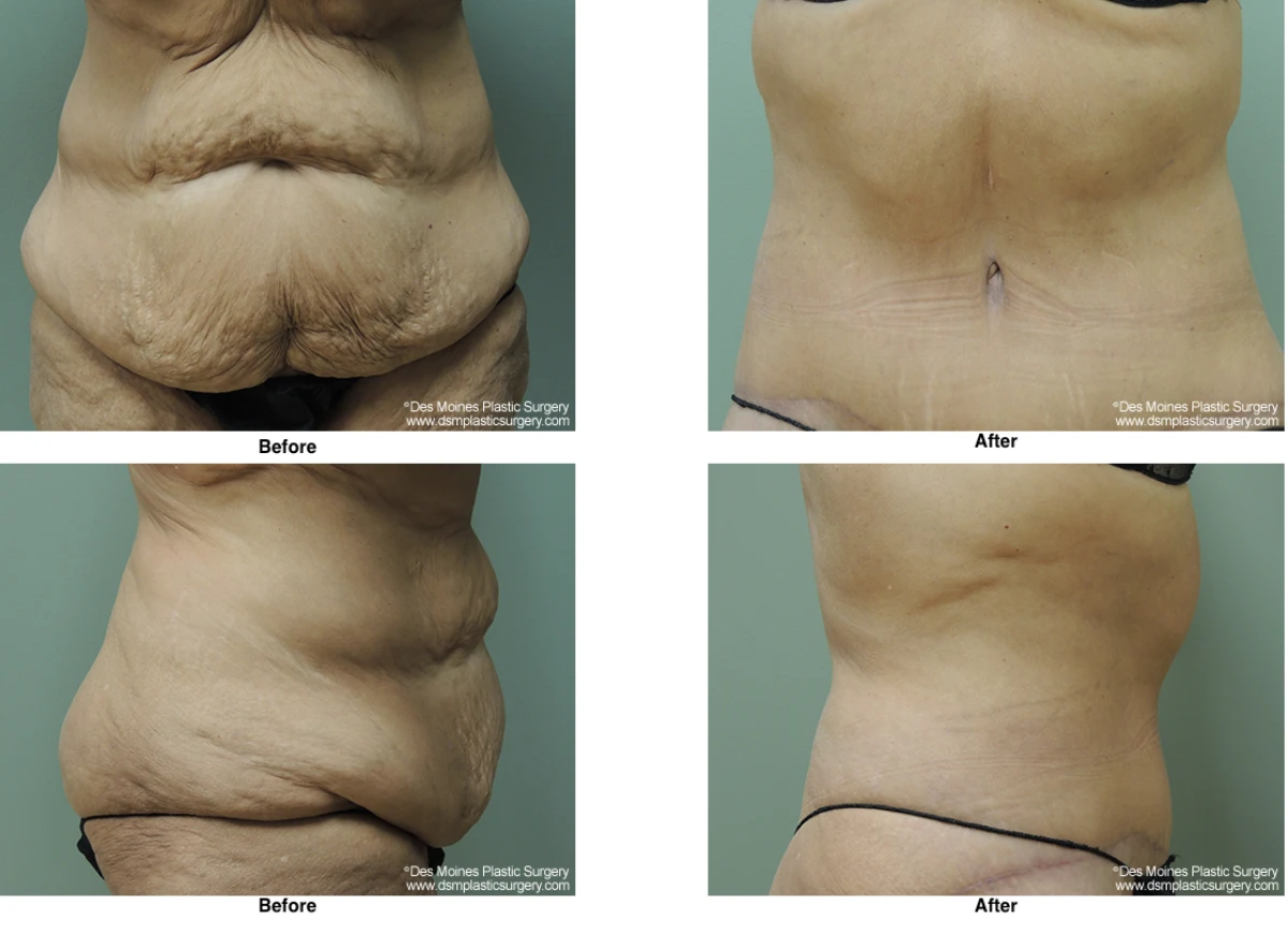 Tummy Tuck Before And After Performed By Dr David Robbins
