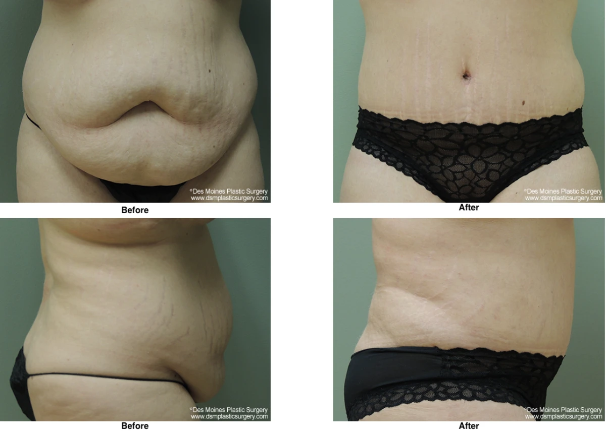 Tummy Tuck Before And After Performed By Dr David Robbins