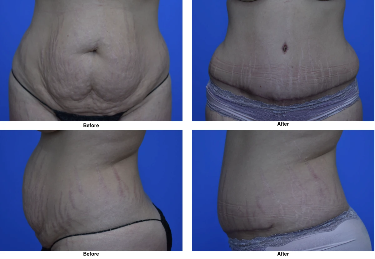Tummy Tuck Before And After Performed By Dr David Robbins