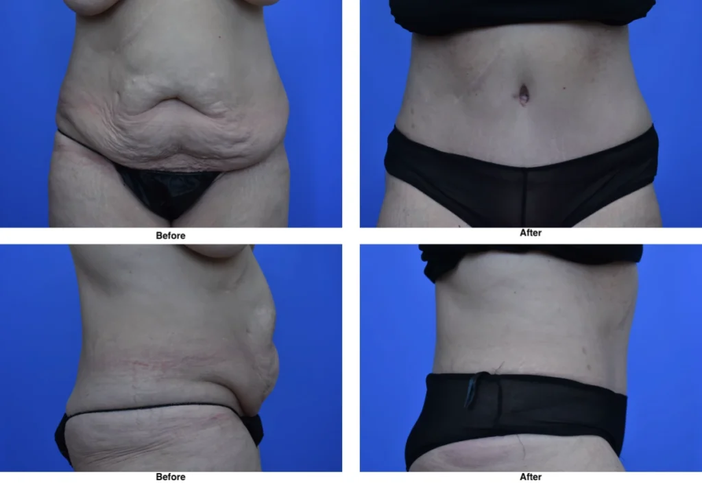 Tummy Tuck Before and After Performed by Dr David Robbins