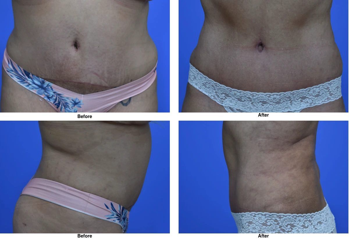 Tummy Tuck Before And After Performed By Dr David Robbins