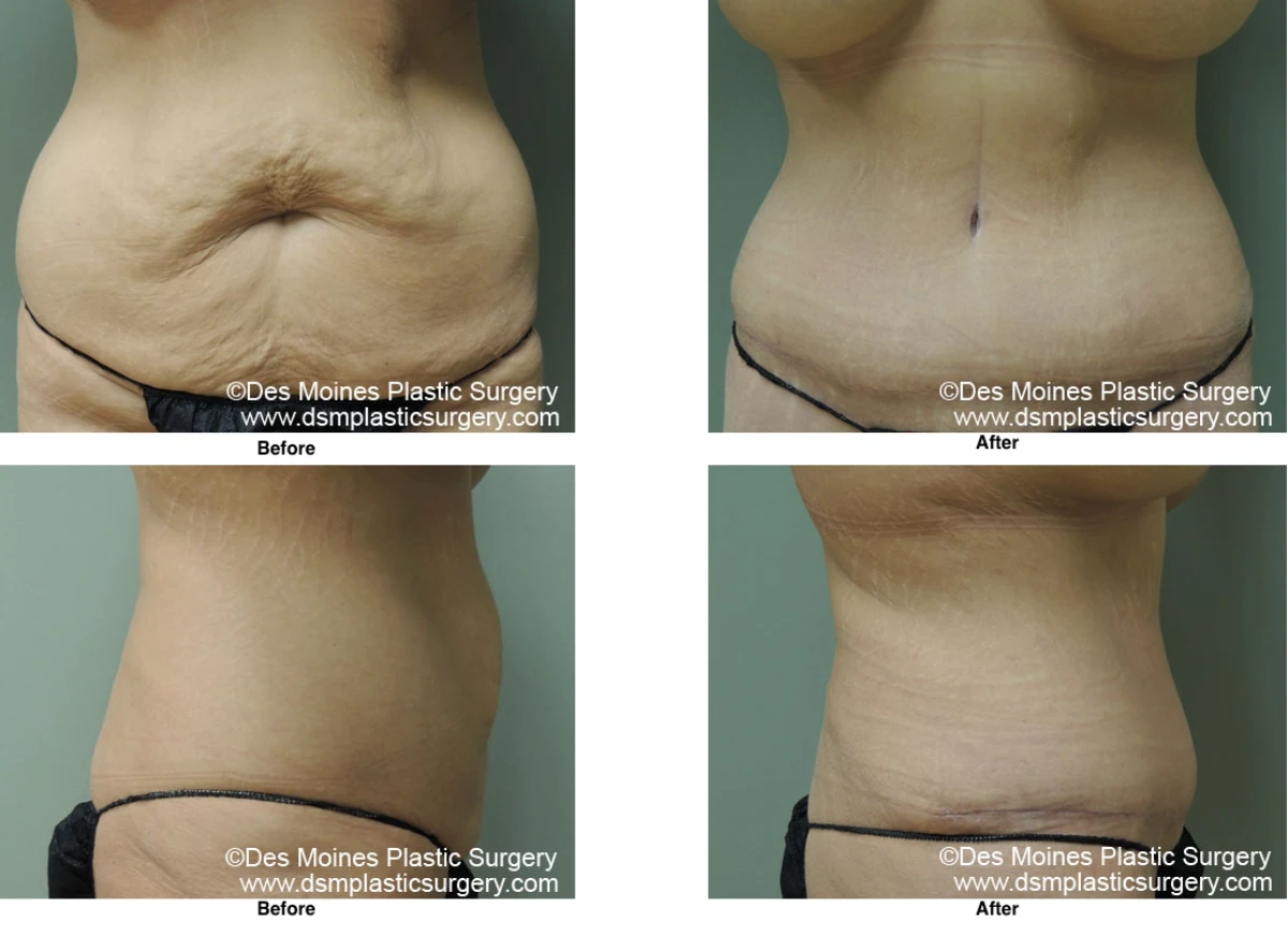Tummy Tuck Before And After Performed By Dr David Robbins