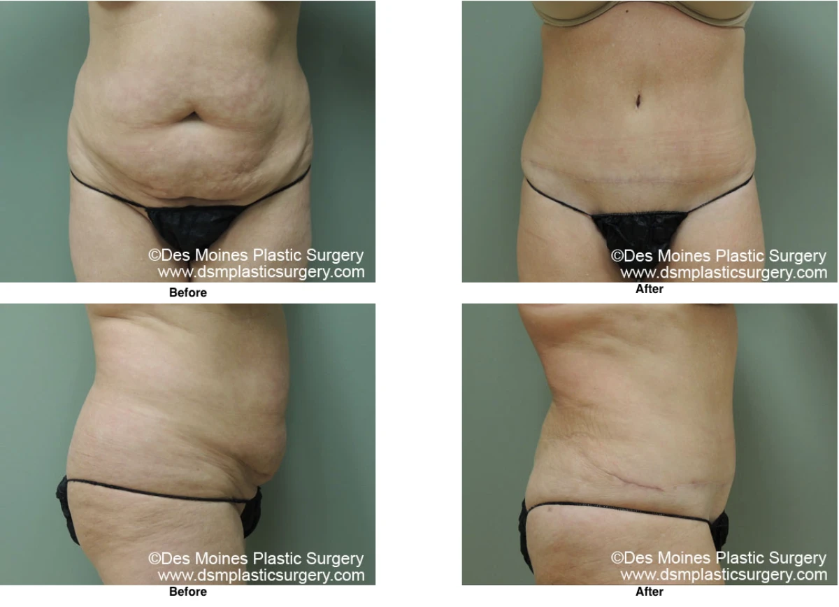 Tummy Tuck Before And After Performed By Dr David Robbins