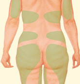 Back Liposuction illustration