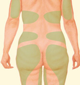 Vectra 3D Imaging 12 Back Liposuction Illustration