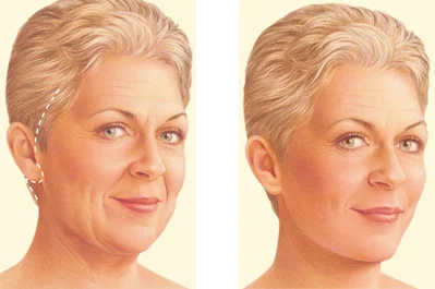diagram showing that the A classic face lift incision is located in the hairline near the temples. It travels around the ear and ends in the lower scalp