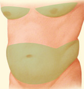 Front Liposuction Before Illustration