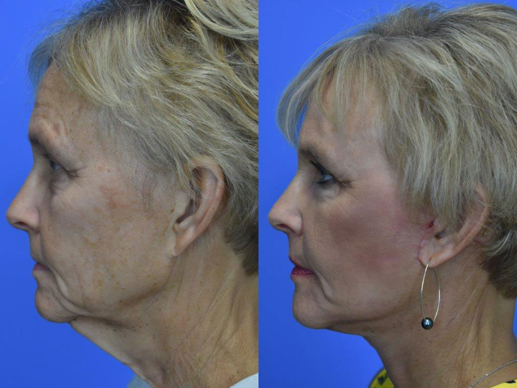 facelift before and after photo