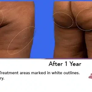 Aveli before and after