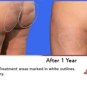 Aveli before and after