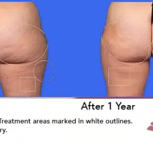 Aveli before and after