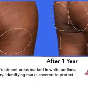 Aveli before and after