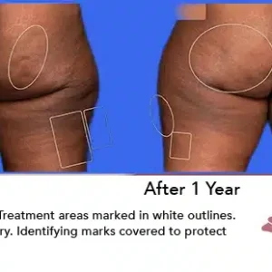 Aveli before and after