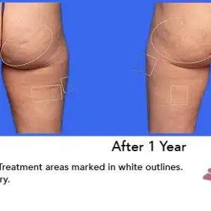 Aveli before and after