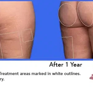 Aveli before and after