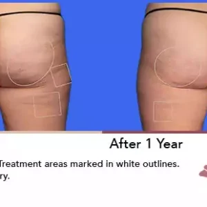 Aveli before and after