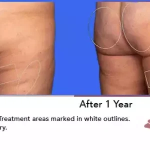 Aveli before and after