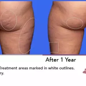 Aveli before and after