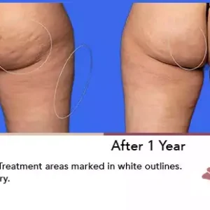 Aveli before and after