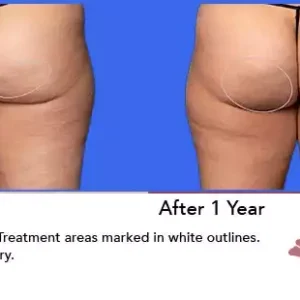 Aveli before and after