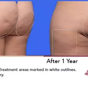 Aveli before and after