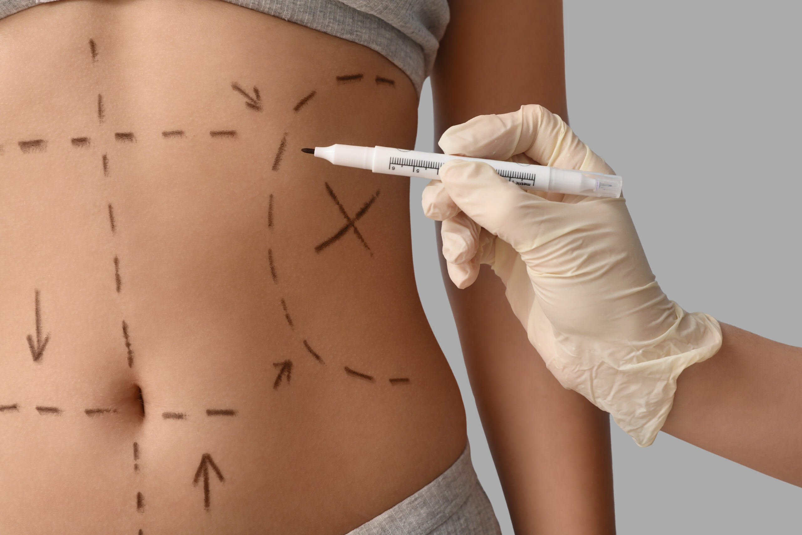 Plastic Surgeon Marking Woman'S Belly On Light Background, Closeup