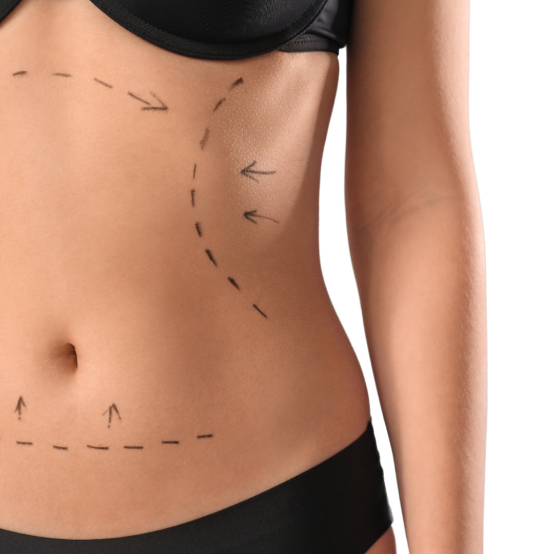 Marks on a woman's belly for body lift surgery on light background, closeup