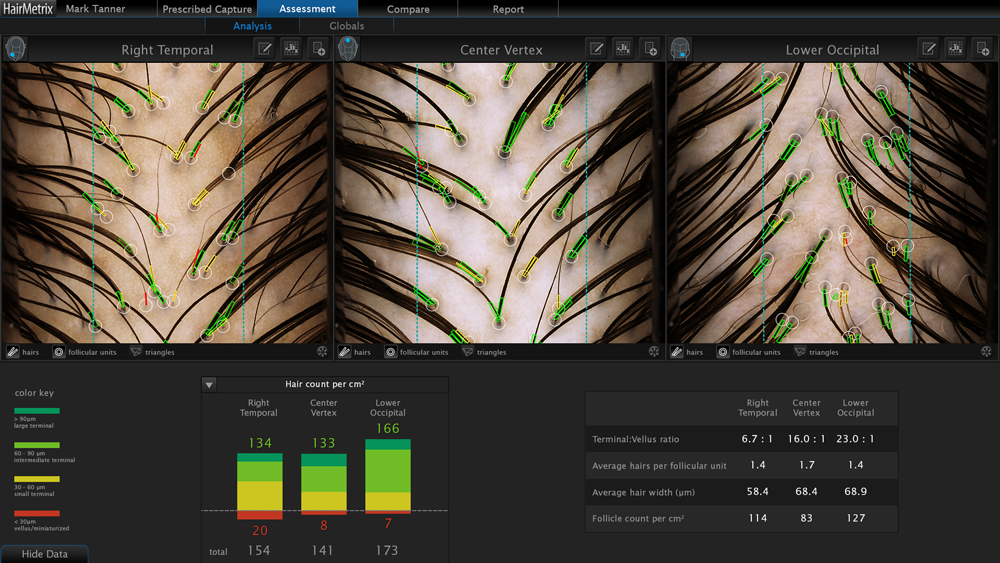 Gethairmd 13 Hairmetrix Analysis