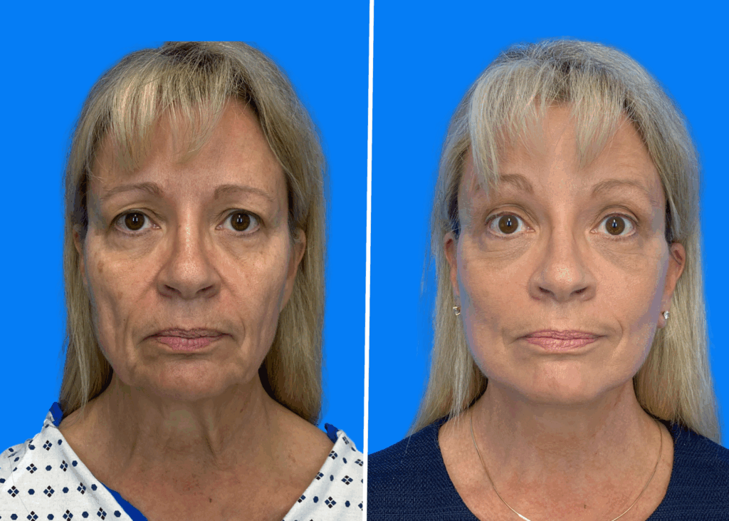 Facelift