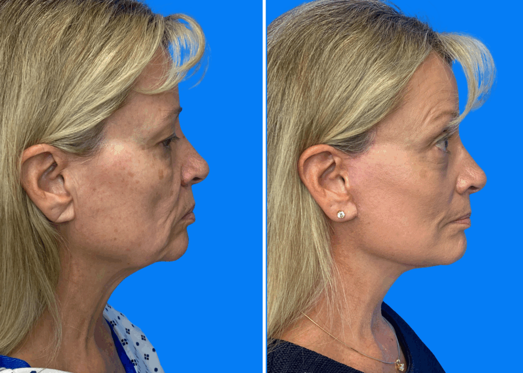 Facelift