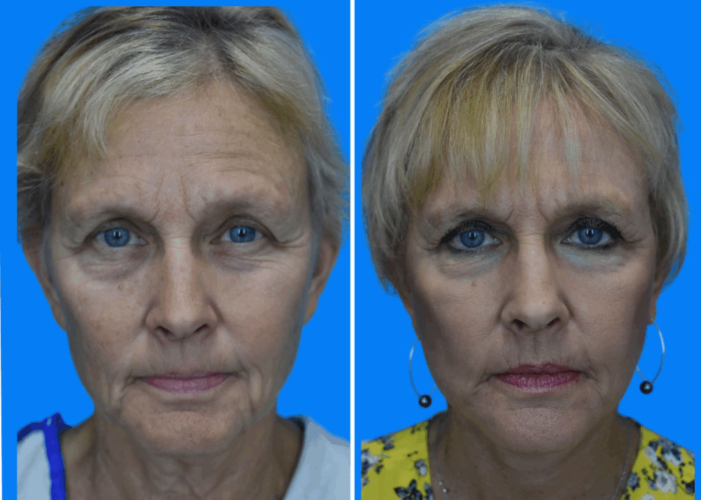 Facelift