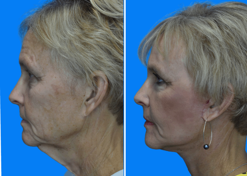 Facelift