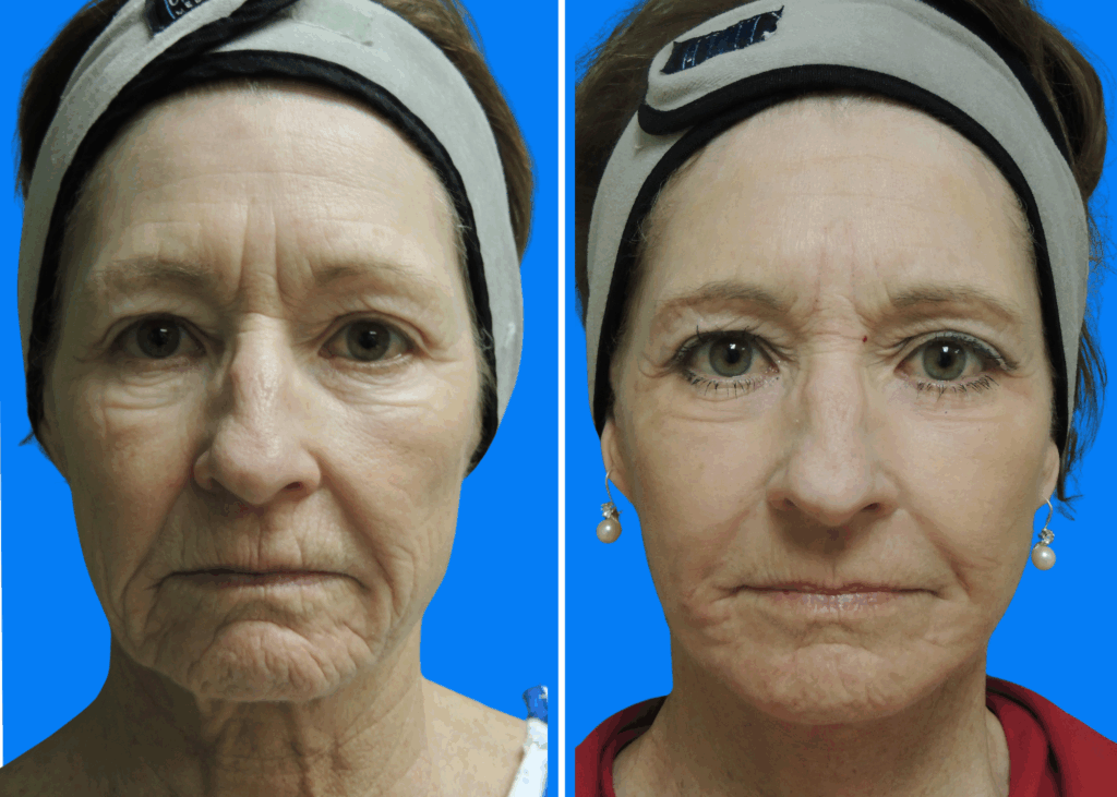 Facelift