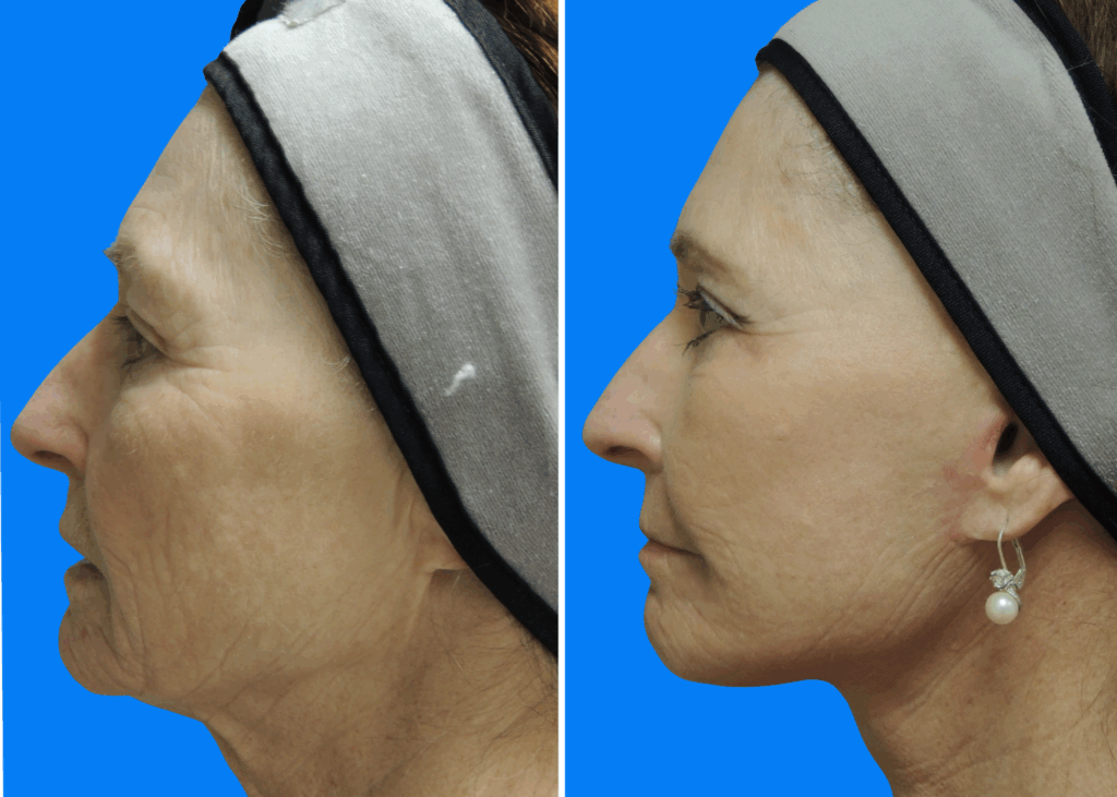Facelift