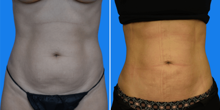 Lipo