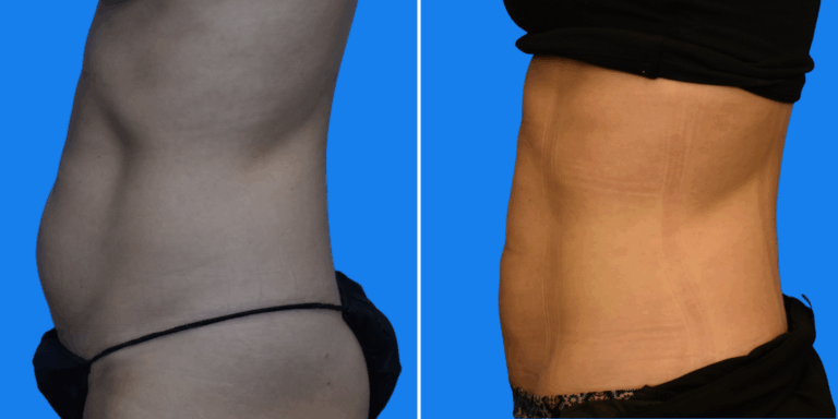 Lipo