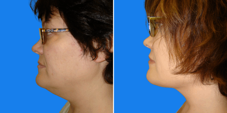 Lipo ()