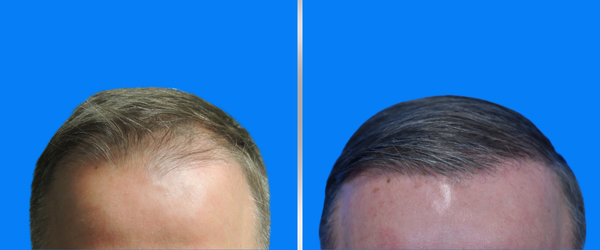 Neograft™ Hair Loss Replacement 2 Neograft Before After Des Moines