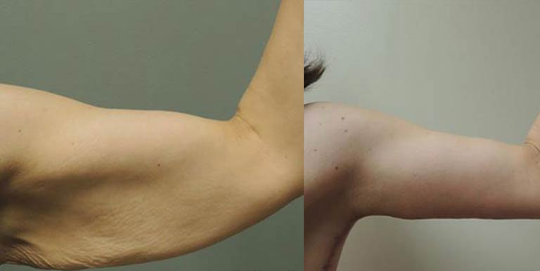 Before & After Photo of a Des Moines Plastic Surgery patient who received Arm Lift treatment