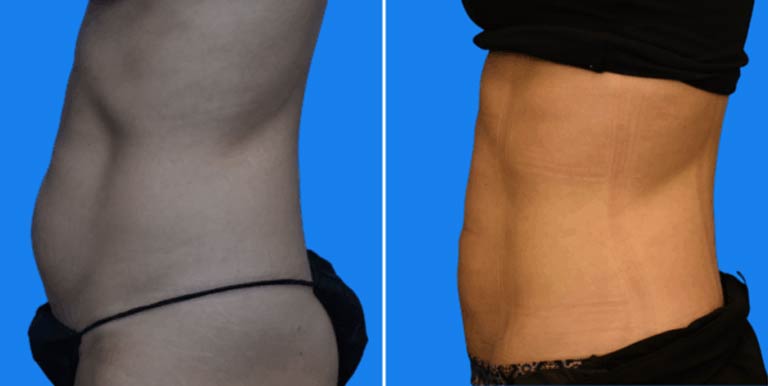 Before & After Photo of a Des Moines Plastic Surgery patient who received Liposuction treatment